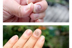 Jangan Abaikan Jamur Kuku, Ini Tips Mudah Mengatasinya