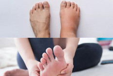 Yuk Cari Tahu! Ini Penyebab Kaki Bengkak dan Cara Mudah Mengatasinya Sebelum Semakin Parah