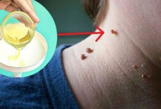 Ternyata Begini Cara Menghilangkan Kutil di Rumah Tanpa Luka, Dokter Sampai Takjub!