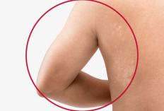 Inilah Solusi Tuntas Kurap di Ketiak dan Leher yang Wajib Kamu Coba!