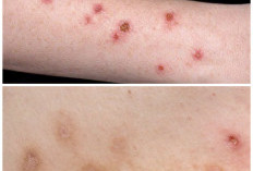 Darah Manis Bikin Kulit Gatal dan Luka Sulit Sembuh? Ini Penjelasan Medis yang Jarang Diketahui!