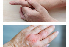 Tips Ampuh Atasi Jari Tangan Bengkak Secara Alami