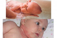 Cara Aman Mengatasi Ruam Panas pada Kulit Bayi