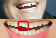 Gigi Depan Anda Patah? Jangan Panik Ini 5 Tips Cepat Untuk Memperbaiki Gigi Yang Patah