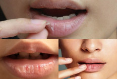 6 Penyebab Yang Bisa Mengakibatkan Bibir Anda Kering 