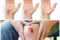 Jangan Diabaikan! Ini 4 Tanda Luka Anda Mulai Sembuh dan Tahapan Rahasia Pemulihan Kulit
