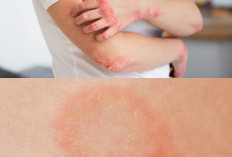 5 Tanda Kurap Akan Sembuh Total dan Tips Menjaga Kebersihan Kulit