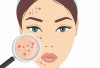 Ketahui! Ini 4 Tips Mengobati Cystic Acne