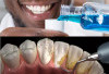 Banyak Belum Tahu Nih, Lakukan 5 Solusi Cepat dan Efektif Untuk Menghilangkan Rasa Ngilu pada Gigi!
