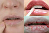 Mau Bibir Anda Sehat? Lakukan 5 Tips Ampuh Mengatasi Bibir Kering dan Pecah-Pecah