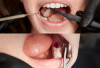 Banyak Belum Tahu Nih, Ini 6 Cara Sederhana Mengurangi Nyeri Gigi Berlubang di Rumah!