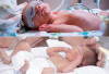 Gangguan Tumbuh Kembang Umum Pada Bayi Prematur